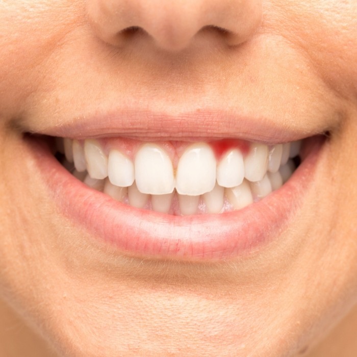 Close up of smile with red gums before gum disease treatment in Plattsburgh
