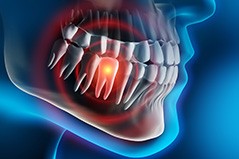 Digital image of a toothache