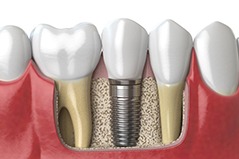 a 3D illustration of a dental implant in the jawbone