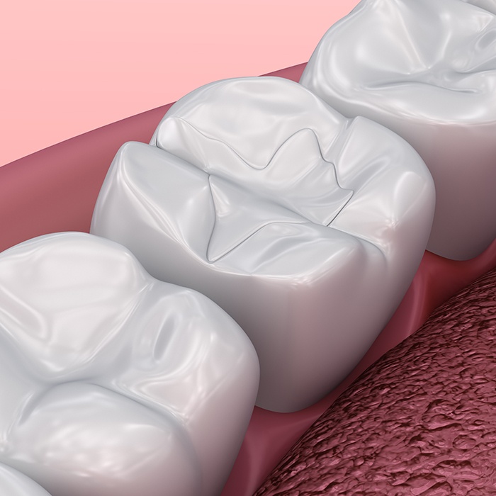 A 3D illustration of tooth-colored fillings