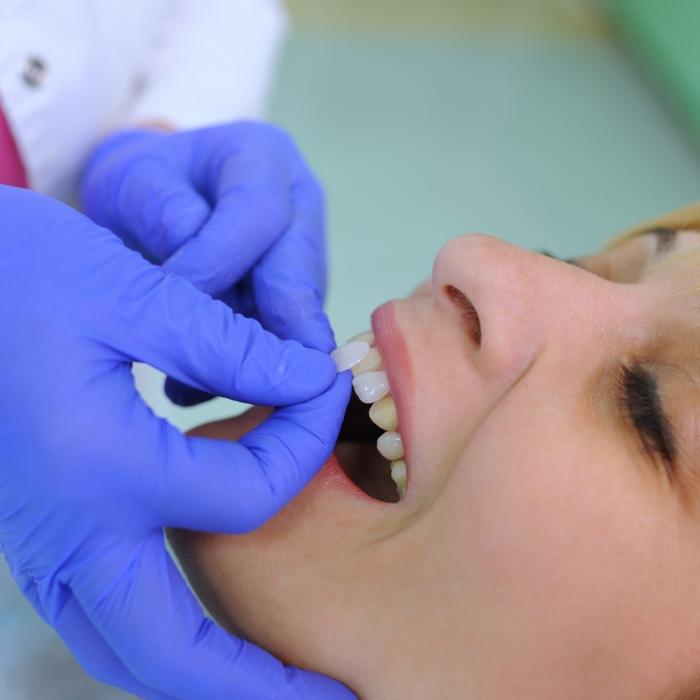 Dentist placing a veneer over the front tooth of a patient